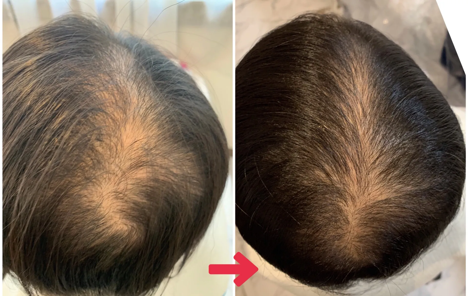 頭髪育毛促進・エクソソーム